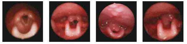 Grading system Supraglottis 0 = No obstruction (full view of vocal cords) 1 = 0-50% Obstruction (vocal cords partially obscured but >50% visible) 2 =