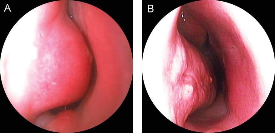 Nasal/Nasopharyngeal Revision adenoidectomy Re-growth not common, but more likely in those undergoing primary adenoidectomy age <3 and with environmental allergies Inferior turbinate reductions No