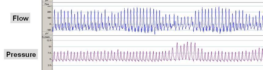 ASV and Minute Ventilation ASV responds to changes in minute ventilation Monitors recent average minute ventilation (~3-min window) It continuously calculates