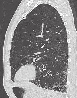 CT in Pulmonary Hypertension verity of lung fibrosis should correlate with the prevalence and extent of pulmonary hypertension.