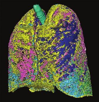 Emphysema is also a well-known etiologic factor of pulmonary hypertension [17].