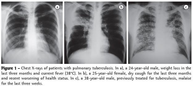 Tuberculosis Highly infectious bacterial lung disease Increased incidence due to AIDS, increased illegal immigration, homelessness (low immune systems) Cough, low grade fever