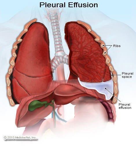 Pleural Effusion: Abnormal amount of fluid surrounding the pleural space.