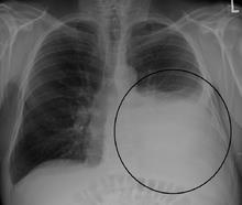 Pleural effusion treatment: Thoracentesis with possible chest tube. This fluid can be various colors due to its cause.