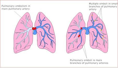 Pulmonary Embolism Blood clot breaks off and travels to the lungs Occurs after surgery