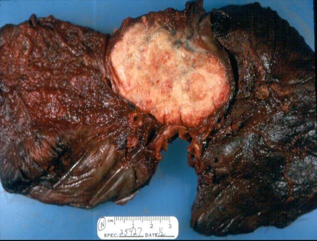 Adenocarcinoma of the lung.