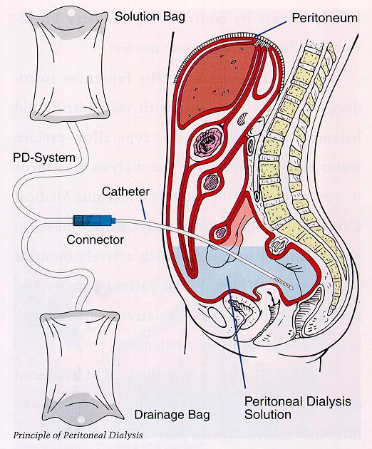 Peritoneal Dialysis Natural Semipermeable Membrane : Peritoneum The transport of substances via Peritoneum occurs in