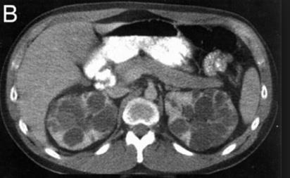 Causes of chronic renal disease Congenital and inherited diseases Polycystic kidney disease Medullary cystic disease Tuberose