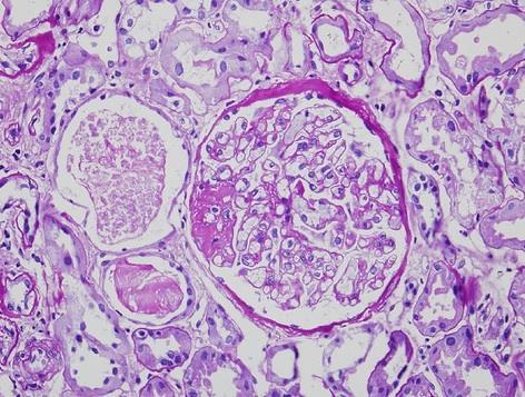 glomerulosclerosis Membranous nephropathy IgA nephropathy
