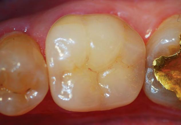 Inlays, Onlays, Veneers and Single Crowns By Dr.