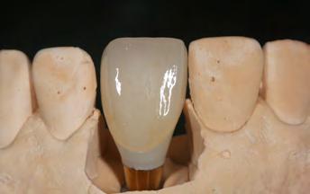 color options (brown, orange, white, grey, pink, violet) to enhance the esthetics of the prosthesis and a