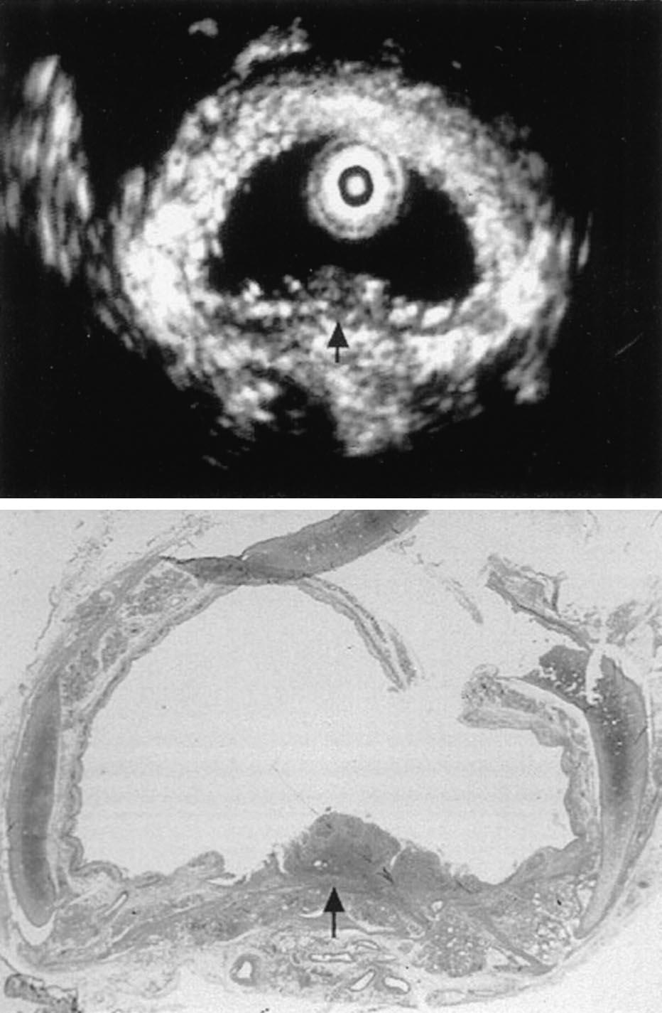 Figure 5. Comparison of ultrasonogram (top) and histopathologic findings (bottom) of a representative example of invasion above the smooth muscle of the membranous portion.