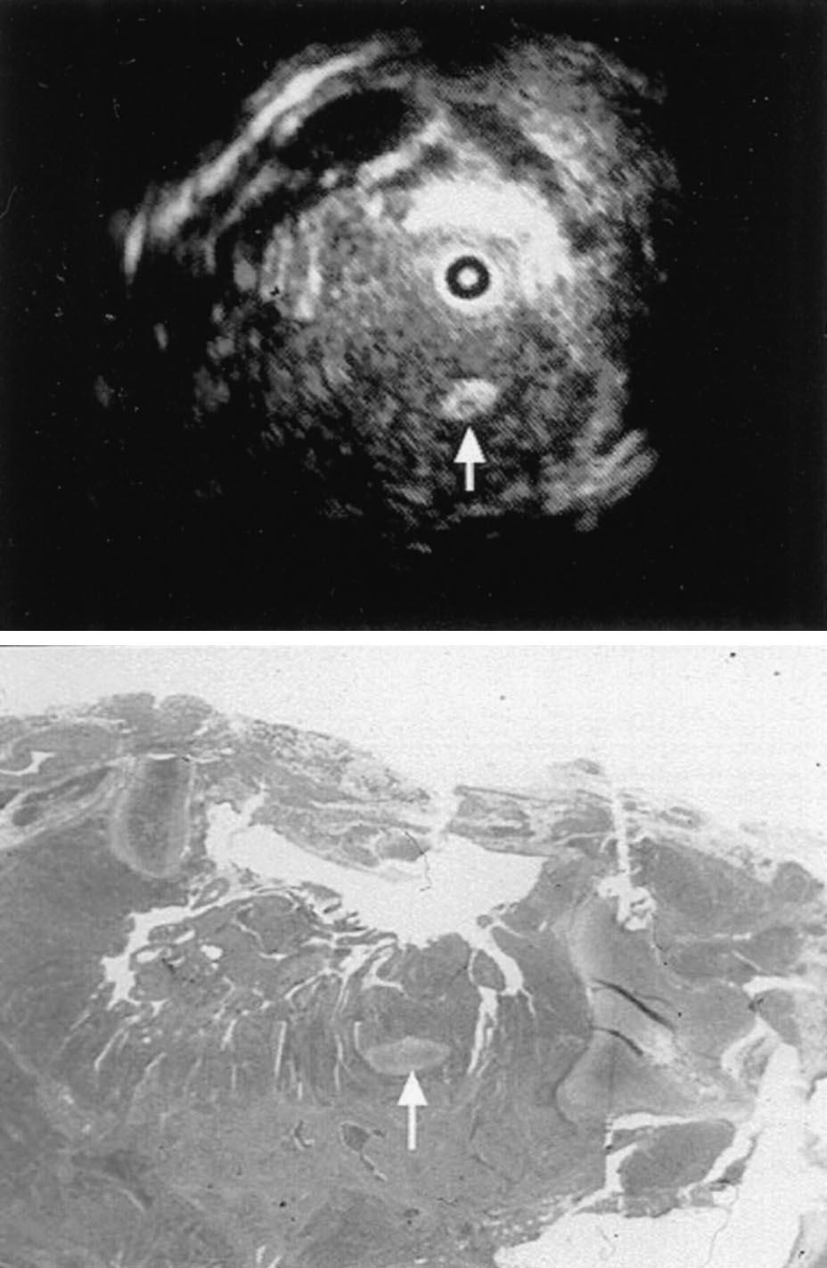 hematoxylin-eosin, original 5). Figure 6. Comparison of ultrasonogram (top) and histopathologic findings (bottom) of a representative example of invasion beyond the bronchial wall.