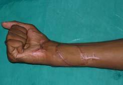 24 years man with full thickness burn on volar aspect of distal forearm with exposed tendons