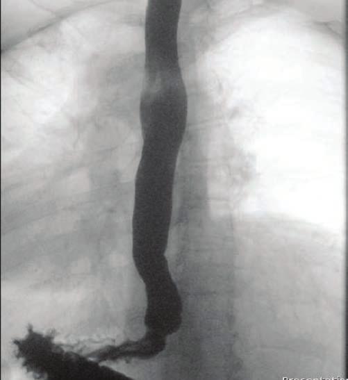 gastro gastroesophageal reflux disease and hiatal hernia 3 a b Figure 3 Barrett esophagus. (a) Schematic and (b) endoscopic images of long segment Barrett esophagus.
