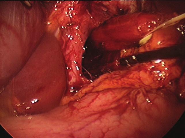 gastro gastroesophageal reflux disease and hiatal hernia 6 Nathanson liver retractor is introduced in the subxiphoid space to retract the left lateral segment of the liver and expose the esophageal