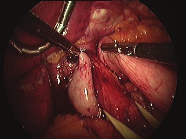 Blunt dissection is then performed on the medial boarder of the right crus and carried superiorly. The phrenoesophageal ligament is then divided in a transverse direction.