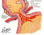 Deteriorated valve between stomach and esophagus allows acid to wash up into