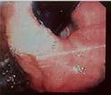 no anatomical reflux barrier Large Hiatus Hernia R Crus L