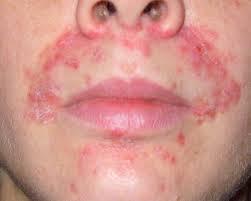 Perioral Facial Dermatitis Clinical Presentation Most often composed of 1 2mm erythematous papules Unlike folliculitis or acne, these lesions are not follicularly based These are most often centered