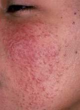Acne VisualDx, 2014 Pearls For Acne Combination antibiotic and retinoid often gain control of disease more quickly, can often back down to just a nightly retinoid when in remission Manage
