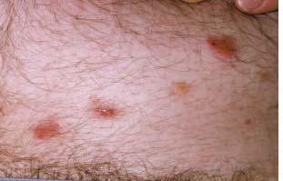 Scabies VisualDx, 2014 Crusted Scabies Also called Norwegian Scabies A very different, highly transmissible form of the disease Many thousands of mites can be