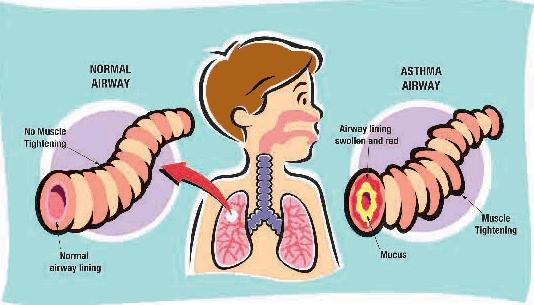 *Asthma Constriction of the bronchi and bronchioles makes it more difficult to breathe in and, especially, out.