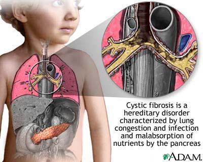 * Cystic fibrosis genetic disorder lungs produce lots of a heavy mucus that plugs the airways interfering with breathing and causing a persistent cough.