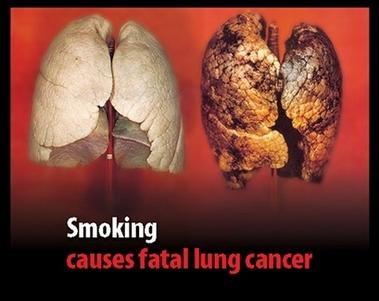 What does smoking do to your lungs? 1. Destroys cilia (tiny hairs that sweep away dust etc.