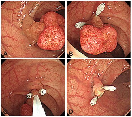 Endoclips What is the Efficacy of Endoscopic Therapy in This Setting?