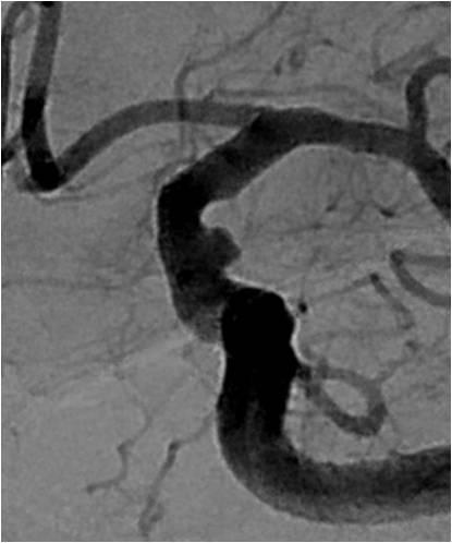 Figure 1: Angiograph at working angle showed a wide-necked aneurysm in the distal internal carotid artery ( 2.3 x 1.4 mm ).