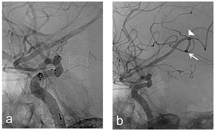 Figure 3: Second migration of coil in stent-assisted coil embolization of an aneurysm. a) 1.