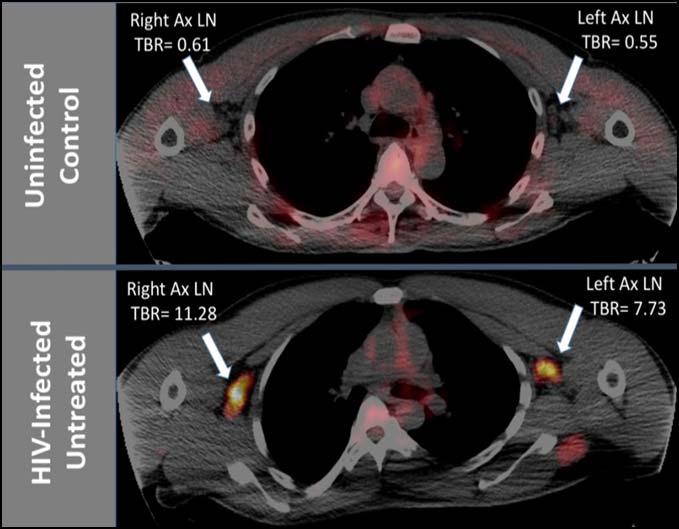 We have performed FDG-PET/CT imaging of lymph nodes to measure the HIV reservoir in humans