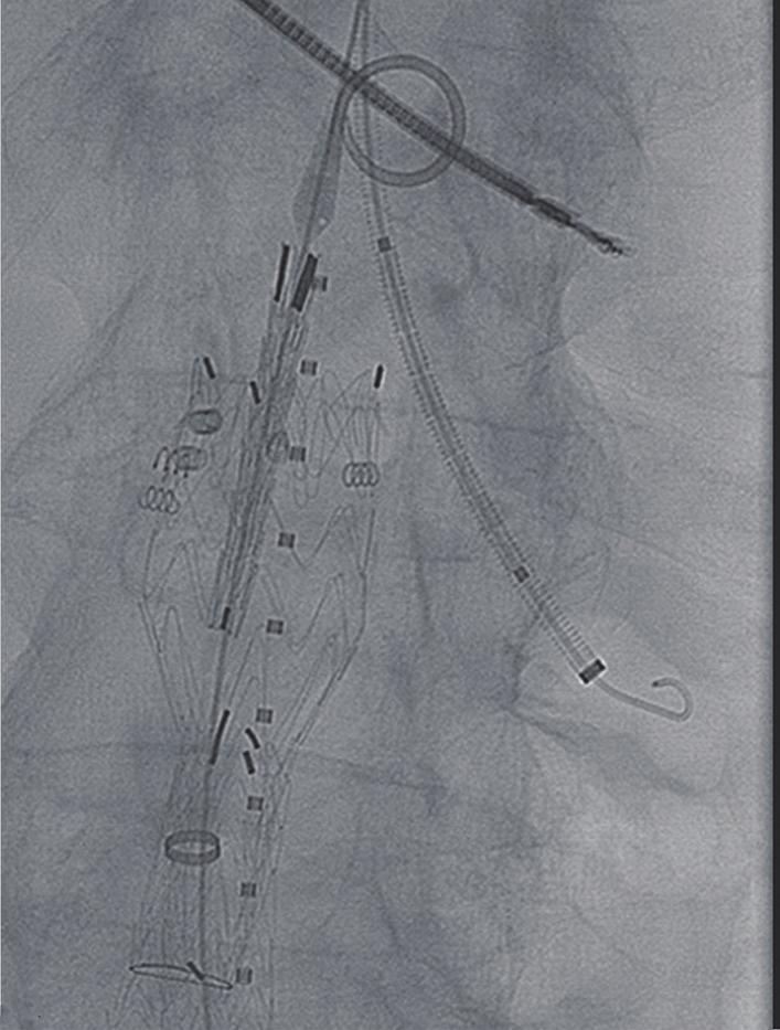 (A,B) Patient underwent proximal extension of the seal zone with simultaneous stenting of the left renal artery using the chimney technique.
