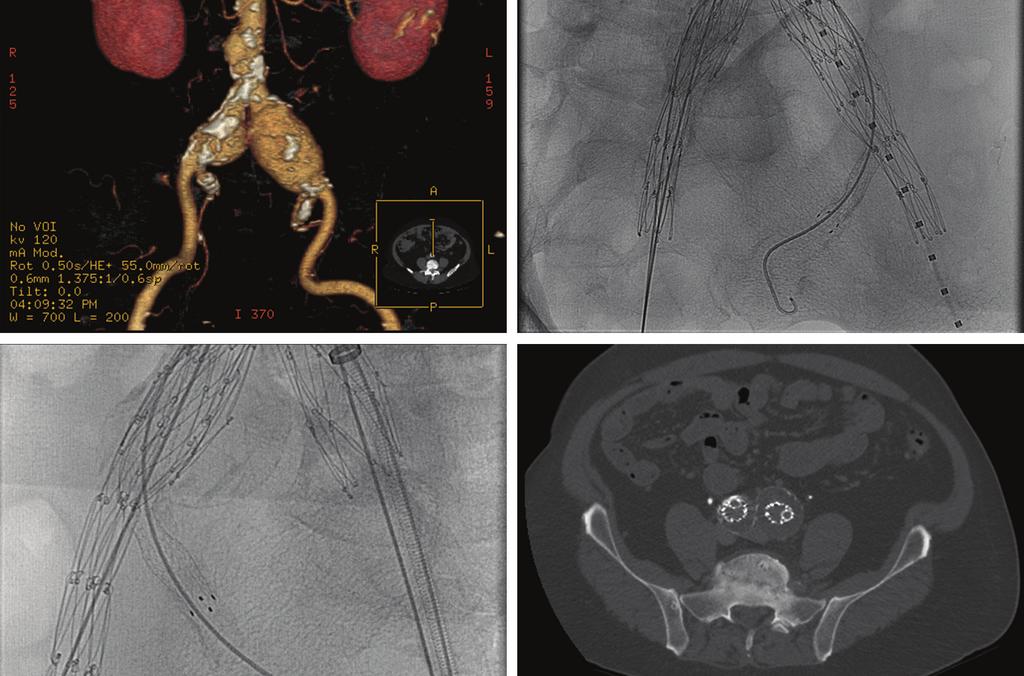 (A) Volume rendering of preoperative CT demonstrates bilateral common iliac artery aneurysms and a small infrarenal aneurysm; (B,C) intra-procedure spot images demonstrate endovascular aortic repair