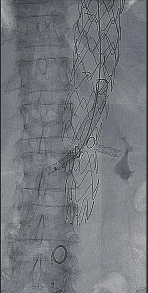 Cardiovascular Diagnosis and Therapy, Vol 8, Suppl 1 April 2018 S179 A B C Figure 3 Seventy yo F with a paravisceral aneurysm that underwent a two stage endovascular repair with a physician modified