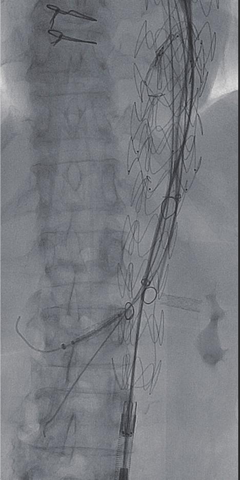 Gore Viabahn stents through the SMA and right renal fenestration creating a branch into their respective target vessels; (C) digital subtraction angiogram of the right renal artery demonstrates
