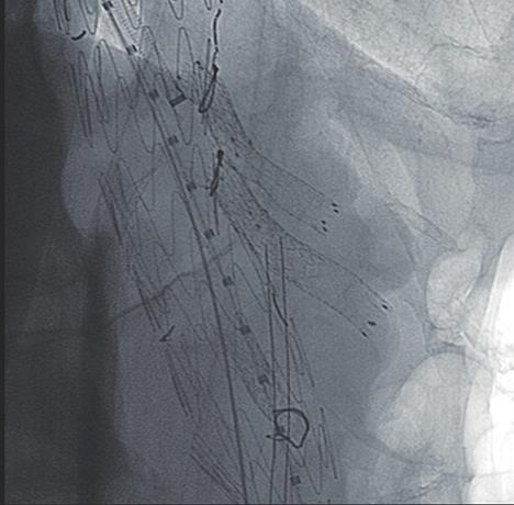 A fenestration was cut to supply the left renal artery.