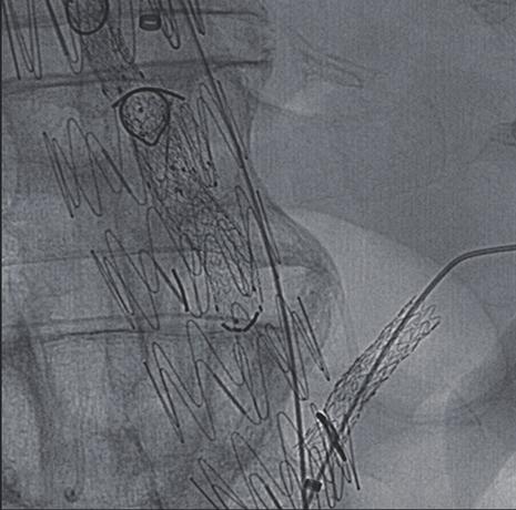 additional Gore Viabahn stents into their target vessels; (C) an anteroposterior spot view shows placement of a Gore Viabahn stent through the left renal fenestration and into the left