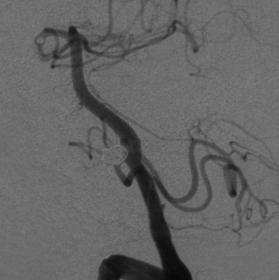 It Performs Diagnosis: A 47-year-old female presented with a right posterior communicating artery aneurysm