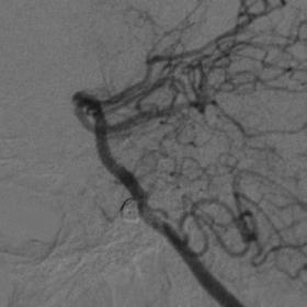 This patient had a left internal carotid artery aneurysm that was previously clipped.