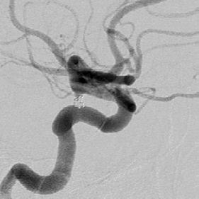 6-Month Follow-Up: Angiography and 3-D reconstruction show complete occlusion of the aneurysm at 6 months.