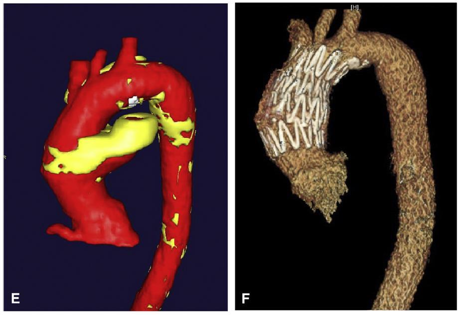 3b) Endovascular Repair Of The Asc Aorta In Pts At High Risk