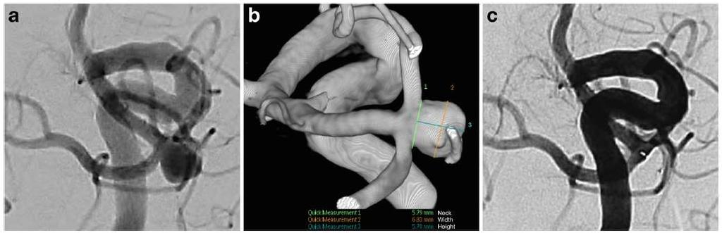 Intrasaccular flow disruption Woven Endobridge (WEB) device for endovascular treatment of ruptured intracranial wide-neck aneurysms: a