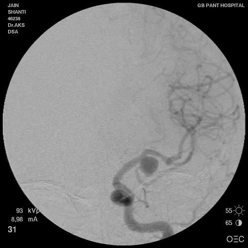 What to do next? Find out the cause of SAH: The commonest cause of SAH is Brain Aneurysm. Brain Aneurysm: The ballooning of brain artery usually at the point where it divides into two.