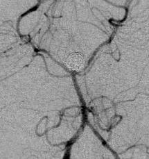 A Clinical Example of a Basilar top Aneurysm presenting with SAH(Grade-I) A 45 yrs male presented with