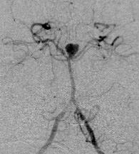Cerebral DSA revealed a Basilar Top aneurysm (fig), which was coiled and patient was discharged from the