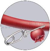 Clipping (Surgical): In surgical clipping, to get to the aneurysm, the surgeon must first remove