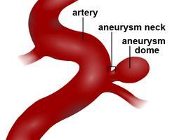 This aneurysm is generally present in the patients right from the beginning of life and keeps growing in size slowly due to high arterial blood pressure.