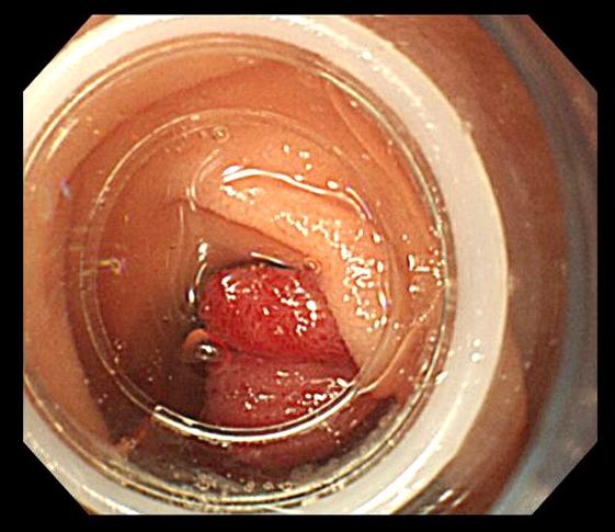 Endoscopy revealed blood in the duodenal bulb and melena, general weakness, and nausea. The patient had no the second portion of the duodenum.